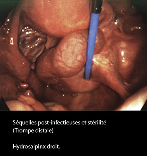 Séquelles post-infectieuses et stérilité tubaire coelioscopie 4