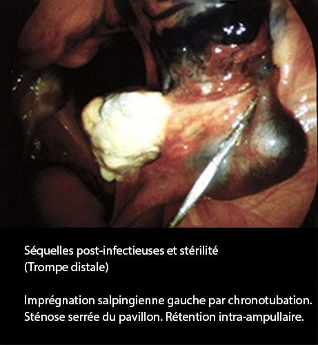 Séquelles post-infectieuses et stérilité tubaire coelioscopie 5