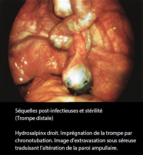 Séquelles post-infectieuses et stérilité tubaire coelioscopie 6