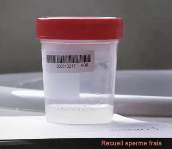 Sperme frais — analyse microscopique séminogramme