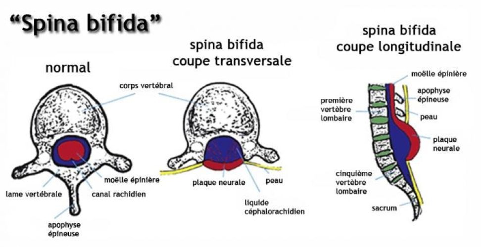 Spina bifida 1