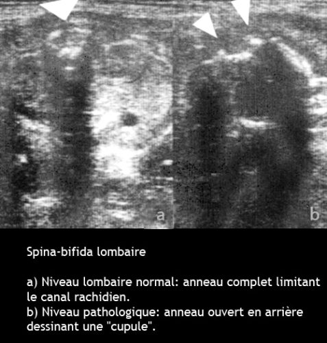 Spina-bifida 1