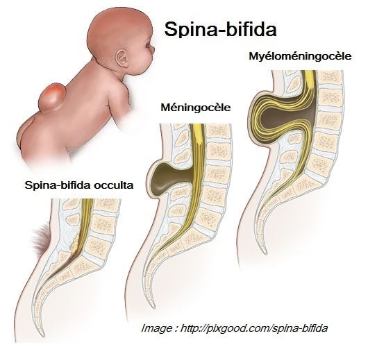 Spina bifida 2