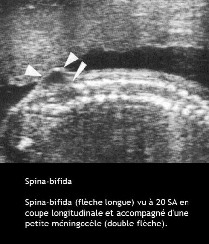 Spina-bifida 2