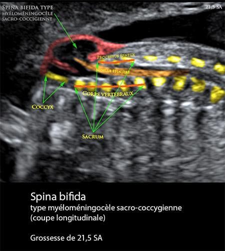 Spina-bifida 21 sa 1