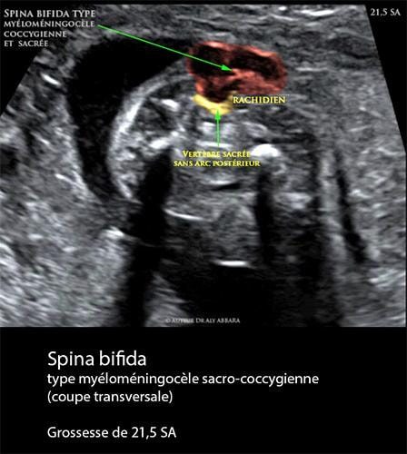 Spina-bifida 21 sa 2