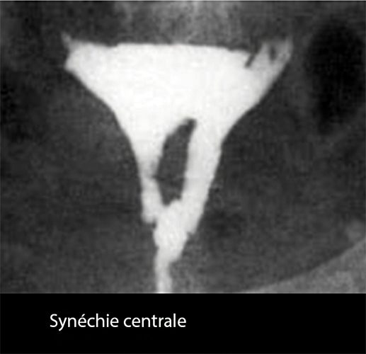 synéchie utérine