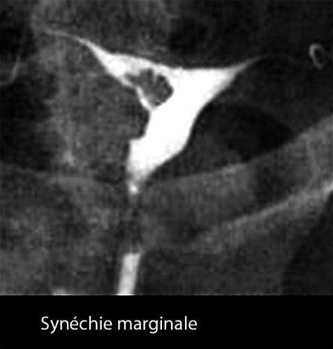 synéchie utérine