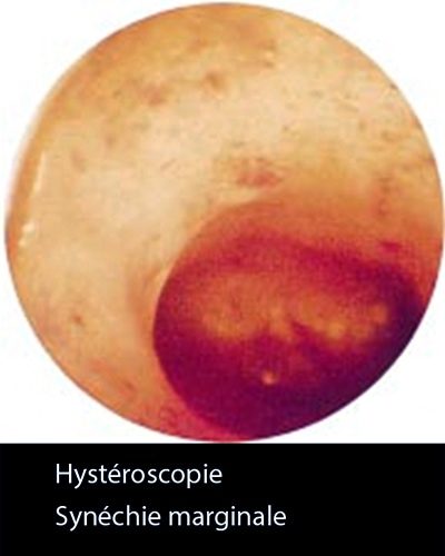 Synéchie 3