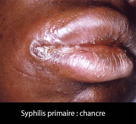 Syphilis Primaire - Dr KARA-ZAITRI M.A