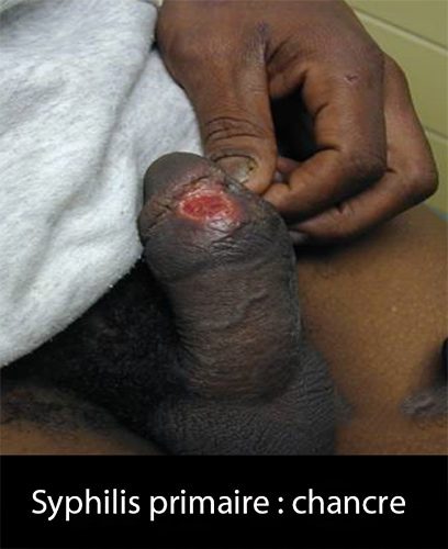Syphilis Primaire - Dr KARA-ZAITRI M.A