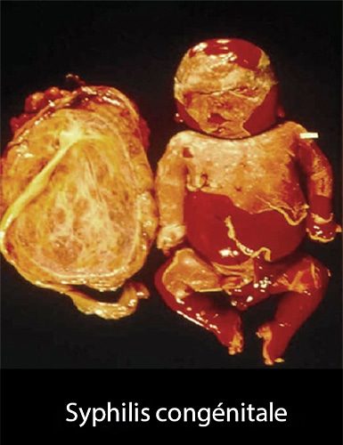 syphilis congénitale
