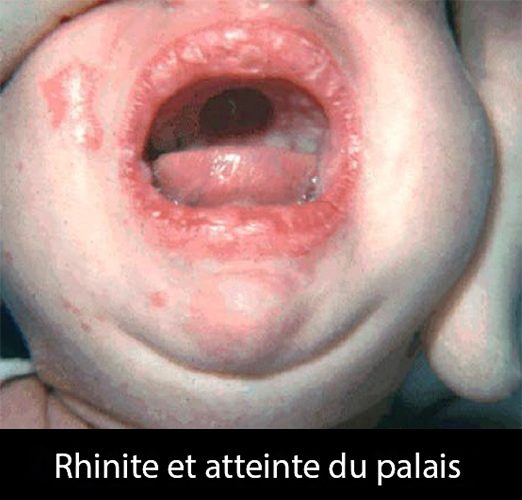 syphilis congénitale