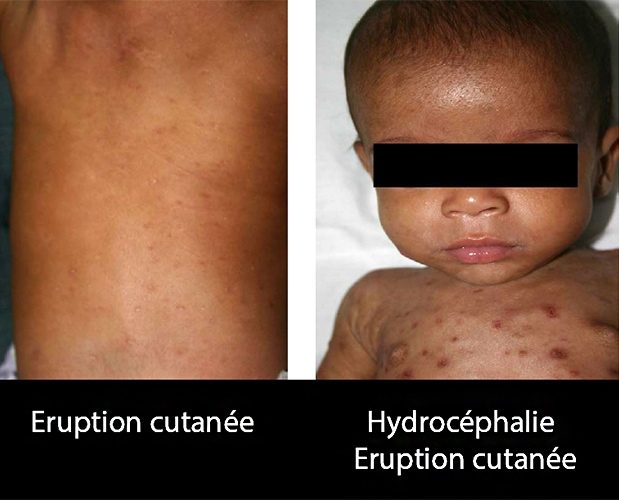 syphilis congénitale