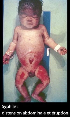 syphilis congénitale