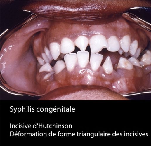 syphilis congénitale