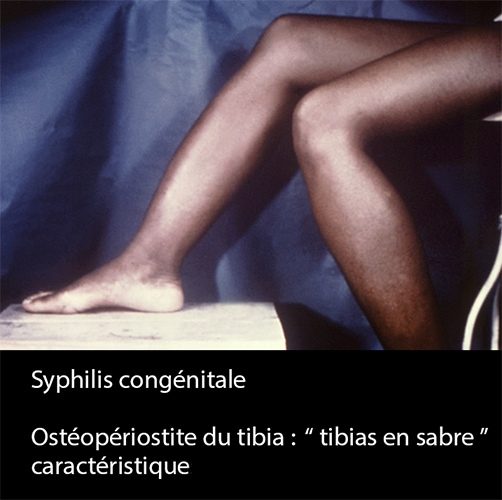 syphilis congénitale