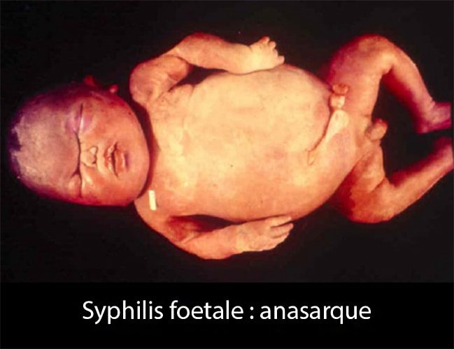 Syphilis cong 2