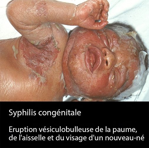 Syphilis cong 3