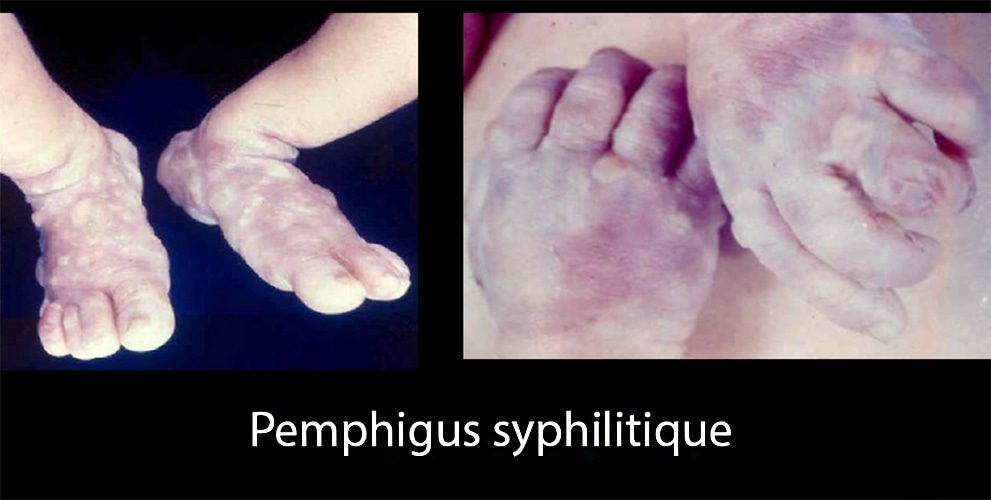syphilis congénitale