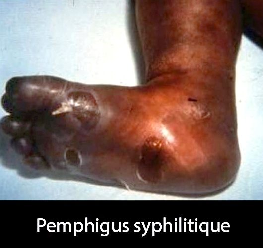syphilis congénitale