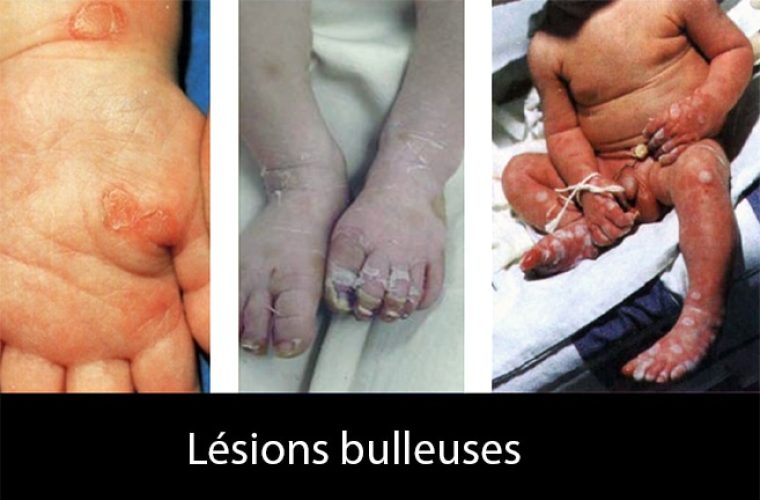 syphilis congénitale