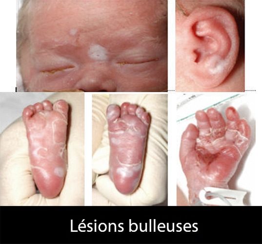 syphilis congénitale