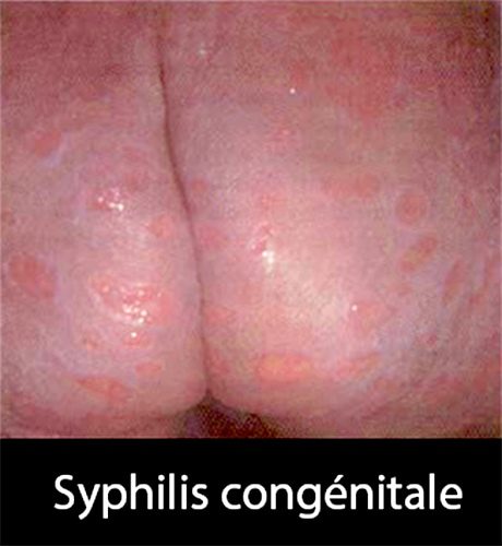 syphilis congénitale