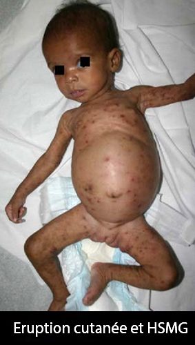 syphilis congénitale