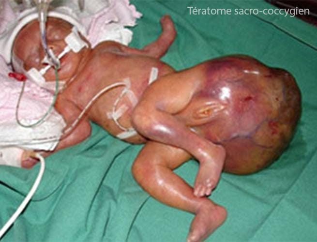 Tératome sc 2