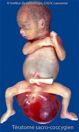 Tératome sc 4