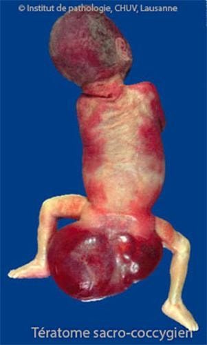 Tératome sc 5