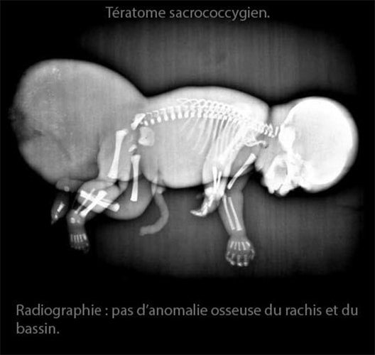 Tératome sc 6
