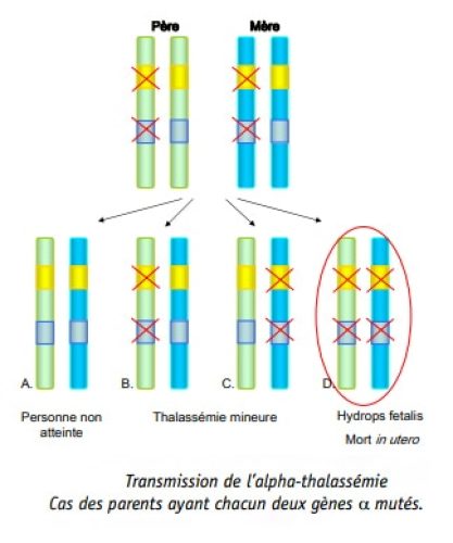 Thalassemie 4