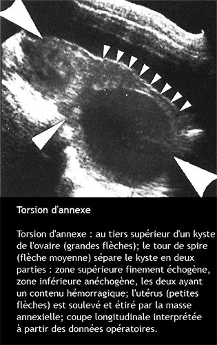 Torsion d'annexe