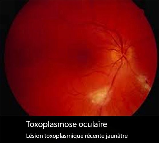 Toxo oculaire 1