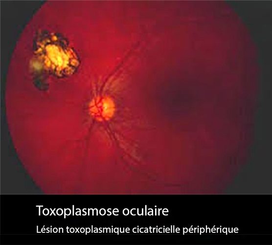 Toxo oculaire 2