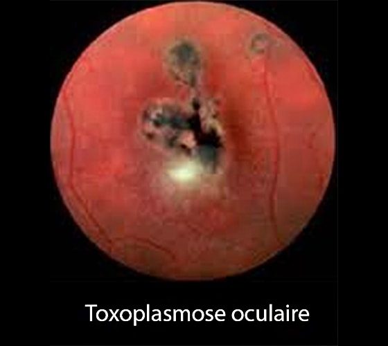 Toxo oculaire 3