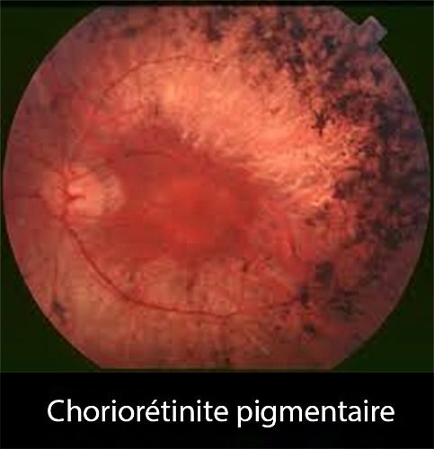 Toxo oculaire 4