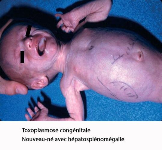 Toxoplasmose — manifestations cliniques infection parasitaire 5