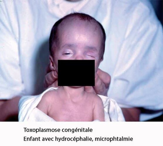 Toxoplasmose — manifestations cliniques infection parasitaire 6