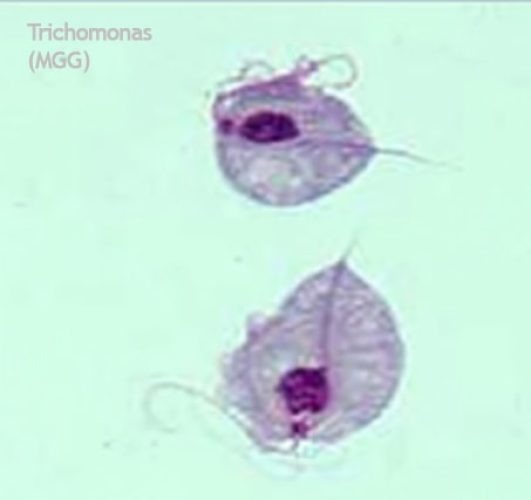 Trichomonas 1