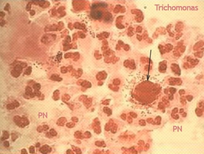 Trichomonas 3