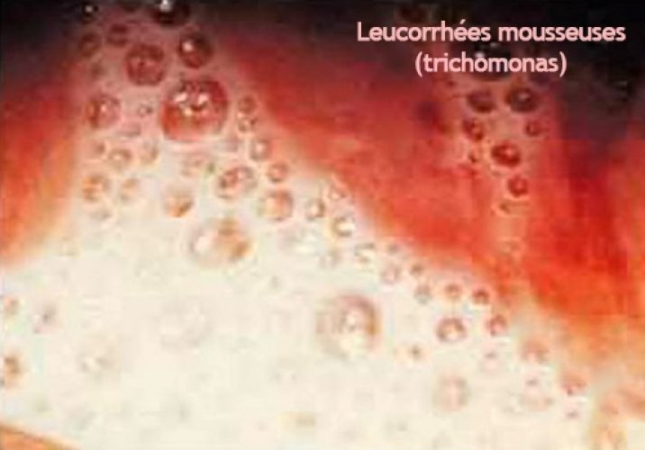 Trichomonas 4