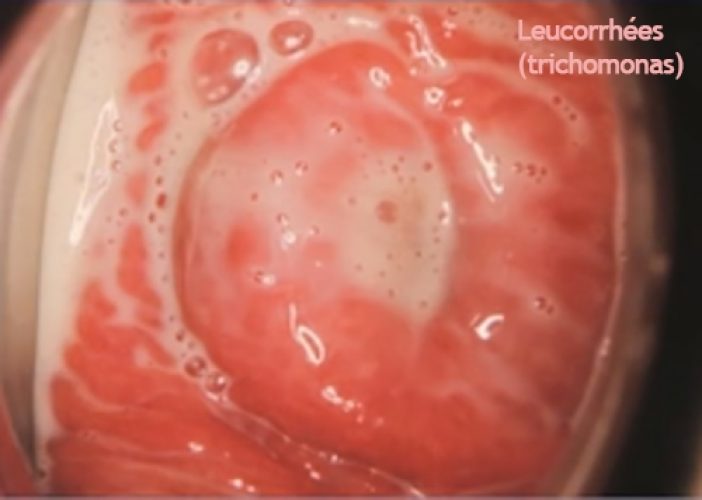 Trichomonas 5