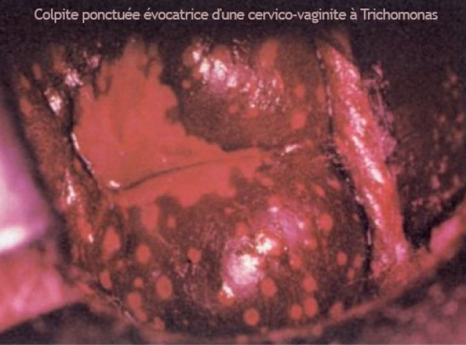 Trichomonas_colpite 3