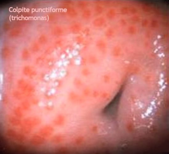 Trichomonas_colpite