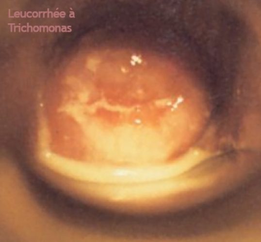 Trichomonas_leucorrhee