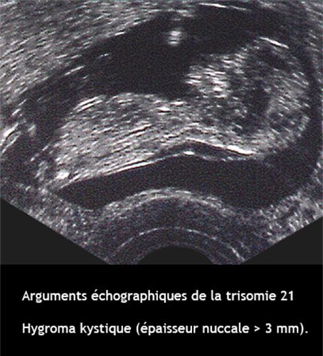 Dépistage de la trisomie 21 — syndrome de Down dysmorphie faciale caractéristiques 1