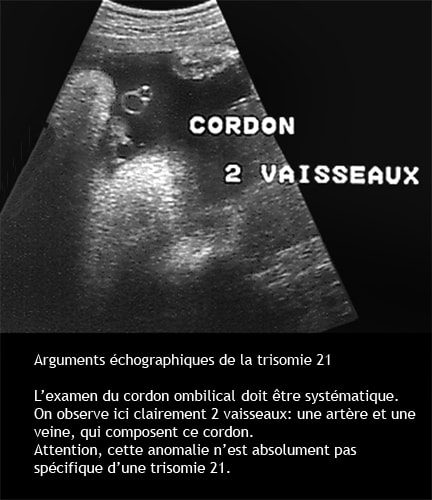 Trisomie 21 — syndrome de Down dysmorphie faciale caractéristiques 10